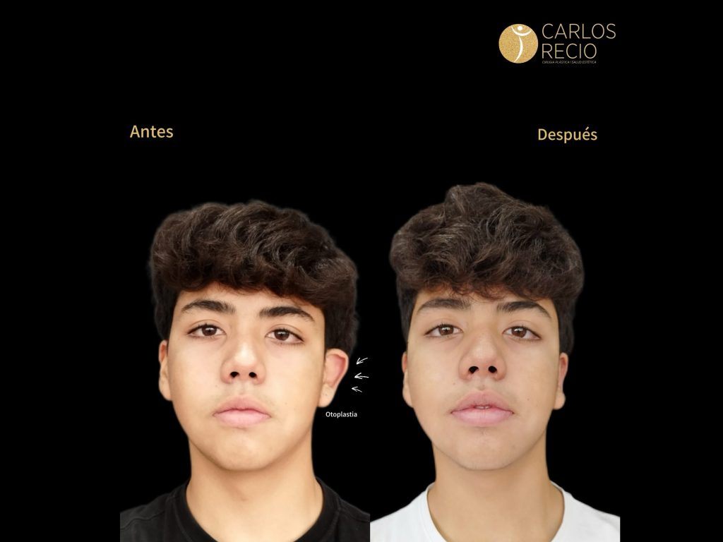 Otoplastia: qué es la cirugía de orejas, a qué edad se puede hacer y cómo es el proceso Otoplastia: qué es la cirugía de orejas, a qué edad se puede hacer y cómo es el proceso